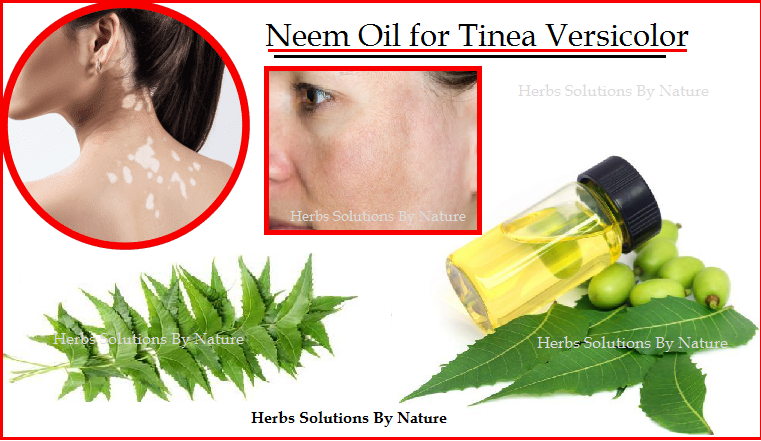 neem-oil-for-tinea-versicolor-natural-remedies-and-natural